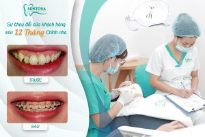 Hình ảnh niềng răng mắc cài – Nha khoa Sentosa – Ca 14