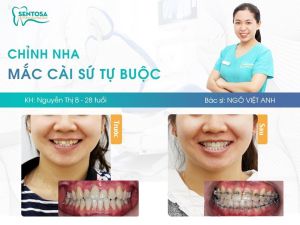 Hình ảnh niềng răng mắc cài của KH Nguyễn Thị B – Nha khoa Sentosa – Ca 2