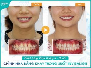 Hình ảnh niềng răng invisalign của KH Phạm Hoàng N – Nha khoa Sentosa – Ca 3