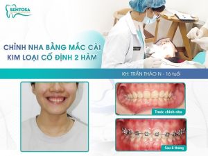 Hình ảnh niềng răng mắc cài của KH Trần Thảo N – Nha khoa Sentosa – Ca 4
