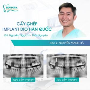 Hình ảnh trồng răng implant của KH Nguyễn Ngọc H – Nha khoa Sentosa – Ca 5