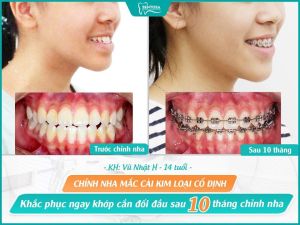 Hình ảnh niềng răng mắc cài của KH Vũ Nhật H – Nha khoa Sentosa – Ca 6