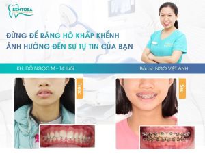 Hình ảnh niềng răng mắc cài của KH Đỗ Ngọc M – Nha khoa Sentosa – Ca 7