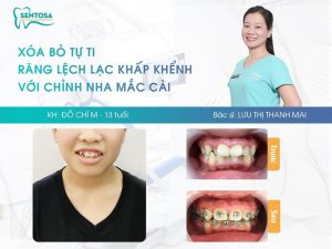 Hình ảnh niềng răng mắc cài của bạn Đỗ Chí M – Nha khoa Sentosa – Ca 8