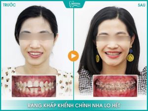 Hình ảnh niềng răng mắc cài – Nha khoa Sentosa – Ca 9