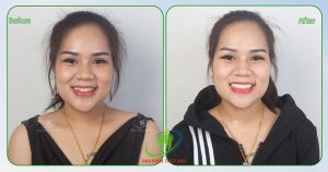 Hình ảnh bọc răng sứ - Ca  11