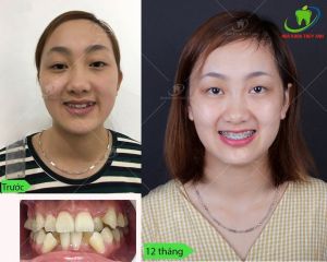 Hình ảnh niềng răng – Ca 12