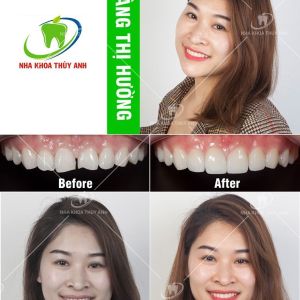 Hình ảnh dán sứ Veneer của KH Hoàng Thị Hường – Ca 15
