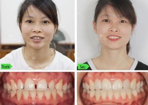 Hình ảnh dán sứ Veneer – Ca 18