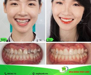 Hình ảnh bọc răng sứ - Ca 19