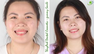 Hình ảnh điều trị cười hở lợi của KH nữ đến từ Đông Anh - Ca 2