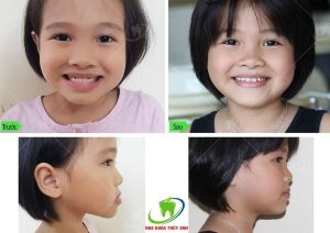 Hình ảnh niềng răng sớm cho trẻ - Ca 20
