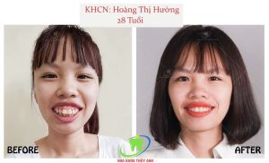 Hình ảnh niềng răng thành công của bạn Hường – Ca 21