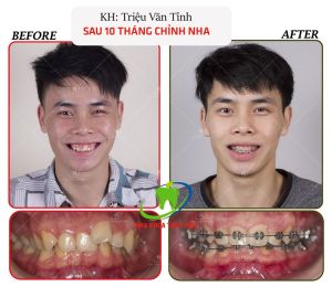 Hình ảnh niềng răng của KH Triệu Văn Tỉnh – Ca 23