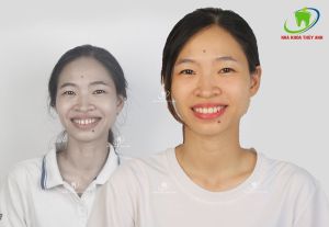 Hình ảnh bọc răng sứ - Ca 25