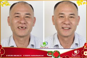 Hình ảnh trồng răng implant – Ca 27