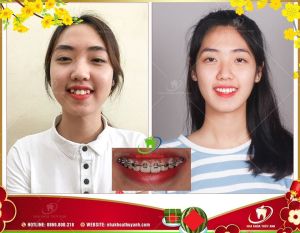 Hình ảnh niềng răng – Ca 29