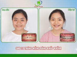 Hình ảnh niềng răng của KH nữ - Ca 3