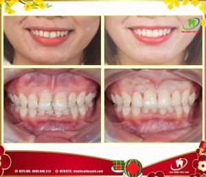 Hình ảnh bọc răng sứ - Ca 31