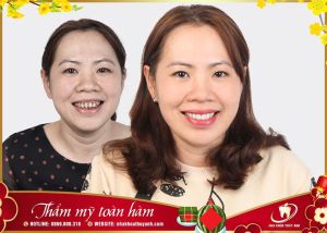 Hình ảnh bọc răng sứ của chị Dương - Ca 32