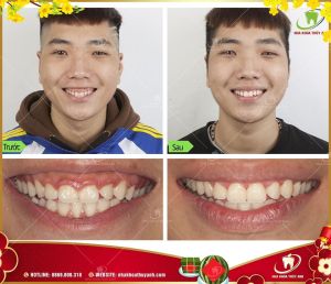 Hình ảnh điều trị cười hở lợi – Ca 33