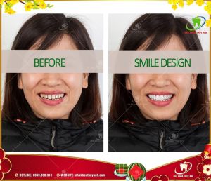 Hình ảnh bọc răng sứ - Ca 34