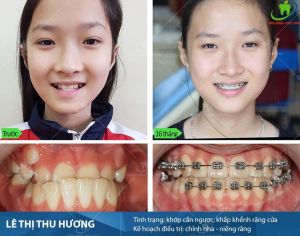Hình ảnh niềng răng của KH Lê Thị Thu Hương – Ca 37