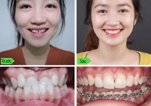 Hình ảnh niềng răng – Ca 38