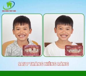 Hình ảnh niềng răng sớm cho bé Phong – Ca 5