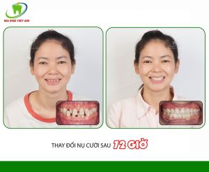 Hình ảnh bọc răng sứ của chị Huyền – Ca 6