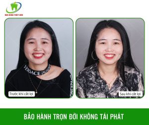 Hình ảnh điều trị cười hở lợi – Ca 7