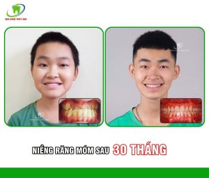 Hình ảnh niềng răng của bé Quang Huy (14 tuổi) – Ca 8