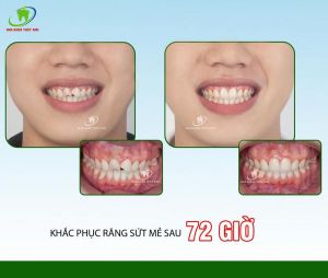 Hình ảnh bọc răng sứ - Ca 9