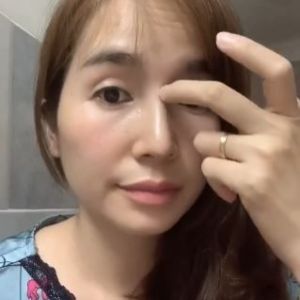 Nâng mũi gần 8 tháng vẫn bị ê ê mũi, đặc biệt là khi nhướn chân mày