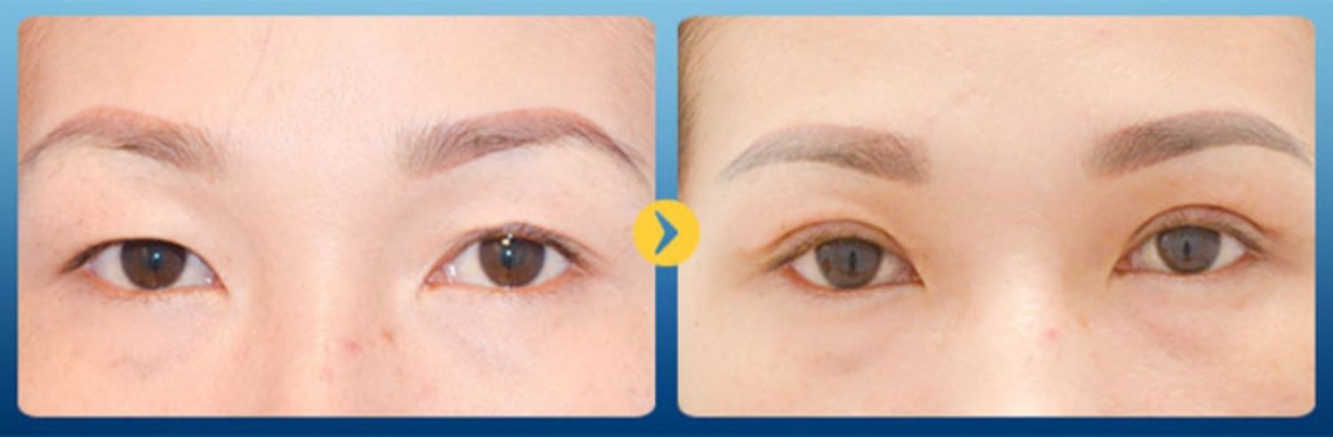 Ảnh trước và sau khi chỉnh nếp mí