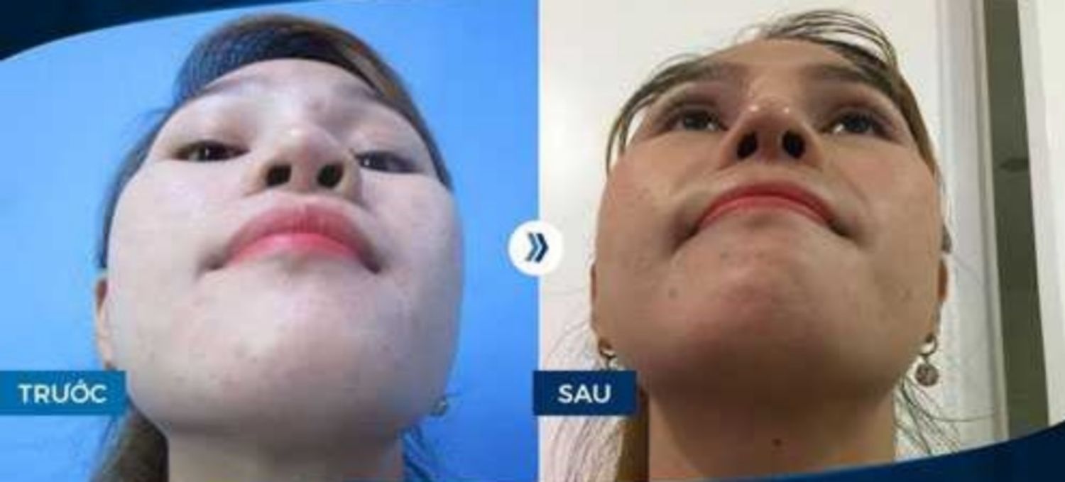 Hình ảnh trước và sau khi chỉnh sửa mũi