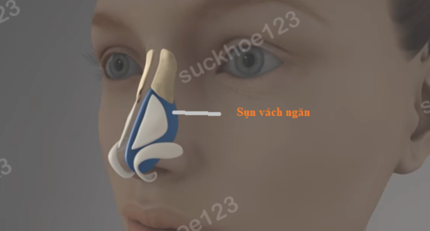 vị trí sụn vách ngăn