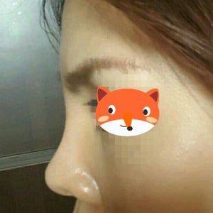 Sống mũi quá cao sau chỉnh sửa 1 tháng? Liệu có thể chỉnh sửa để rút sụn hoặc thay đổi không?