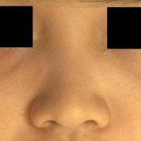 Sống mũi thấp, có thể khắc phục mà không dùng sụn nhân tạo không? Sống mũi thấp, có thể khắc phục mà không dùng sụn nhân tạo không?