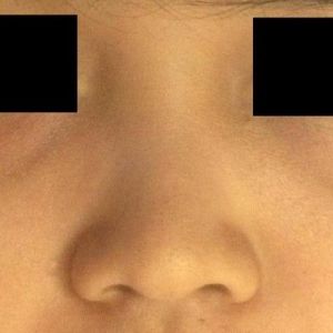Sống mũi thấp, có thể khắc phục mà không dùng sụn nhân tạo không?
