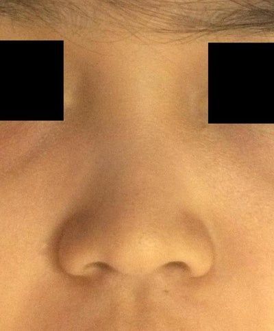 Sống mũi thấp, có thể khắc phục mà không dùng sụn nhân tạo không?