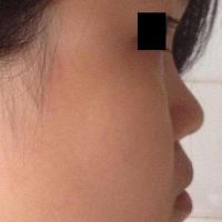 Sống mũi thấp, có thể khắc phục mà không dùng sụn nhân tạo không? Sống mũi thấp, có thể khắc phục mà không dùng sụn nhân tạo không?