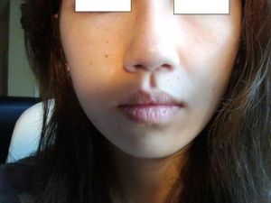 Mũi “củ hành” của tôi có thể chỉnh sửa được bằng phương pháp mổ kín không?