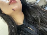 Tiêm filler juve bầm tím