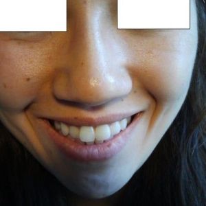 Mũi “củ hành” của tôi có thể chỉnh sửa được bằng phương pháp mổ kín không?