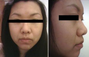 Có thể nâng mũi cho trường hợp có mô mũi quá dày không?