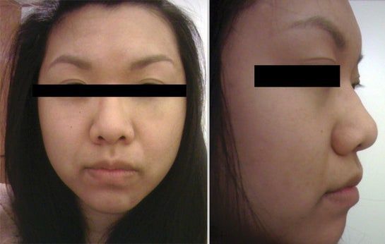 Có thể nâng mũi cho trường hợp có mô mũi quá dày không? Có thể nâng mũi cho trường hợp có mô mũi quá dày không?