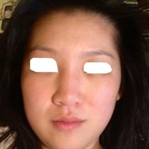 Có tiền sử co thắt bao xơ với túi độn ngực thì nâng mũi bằng silicone có sợ mũi co rút không?