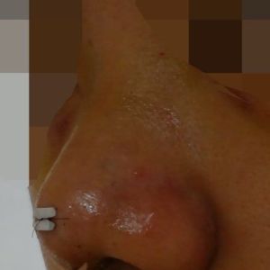 Mũi quá ngắn và bị hếch sau khi phẫu thuật tạo hình đầu mũi