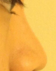 Chỉnh sửa trụ mũi co rút và đầu mũi thấp